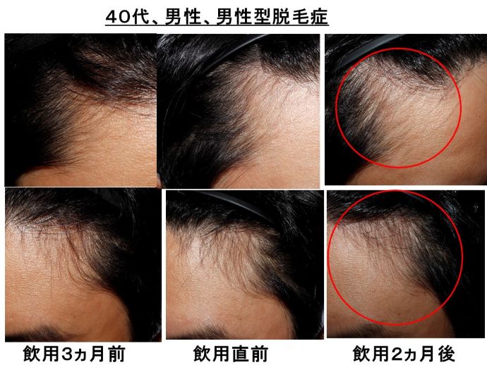円形脱毛症　病院
